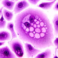 Researchers use genetically engineered immune cells to put a child’s metastatic cancer into remission